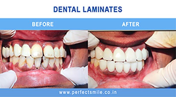 Dental laminates before and after
