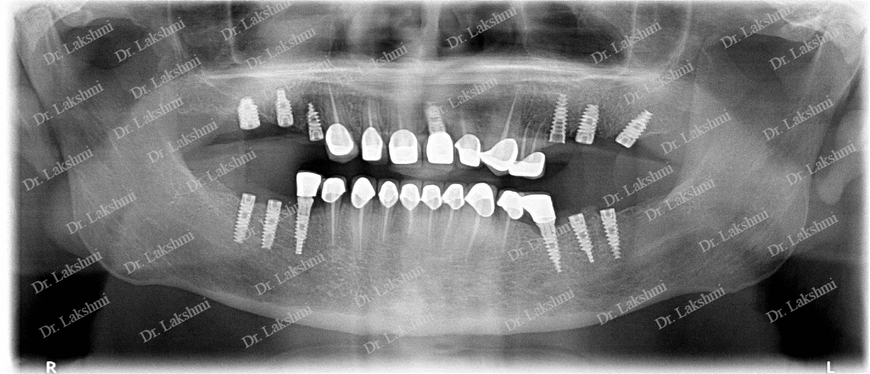 Dental Implants Bangalore
