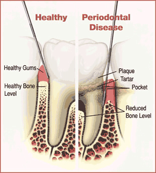 periodontal.html