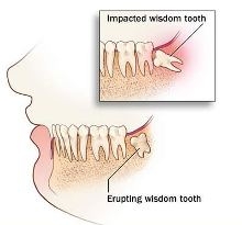 wisdom_teeth.html