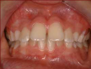 invisible-braces.html