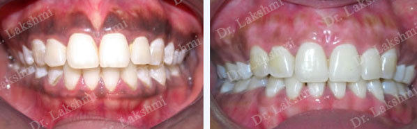 Depigmentation of Gums before and After