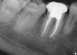 Root canal Treatment: Prevention from complete decay of teeth