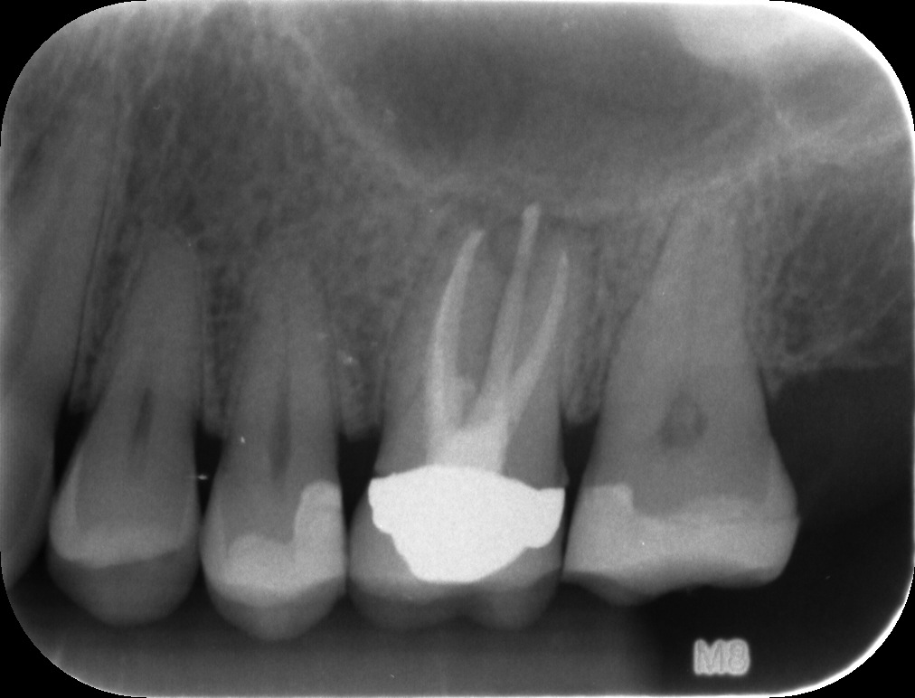 root canal treatment steps