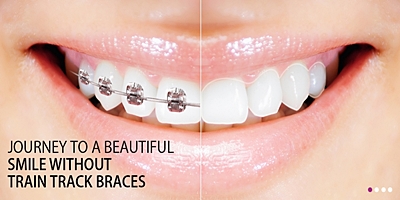 invisible braces bangalore cost