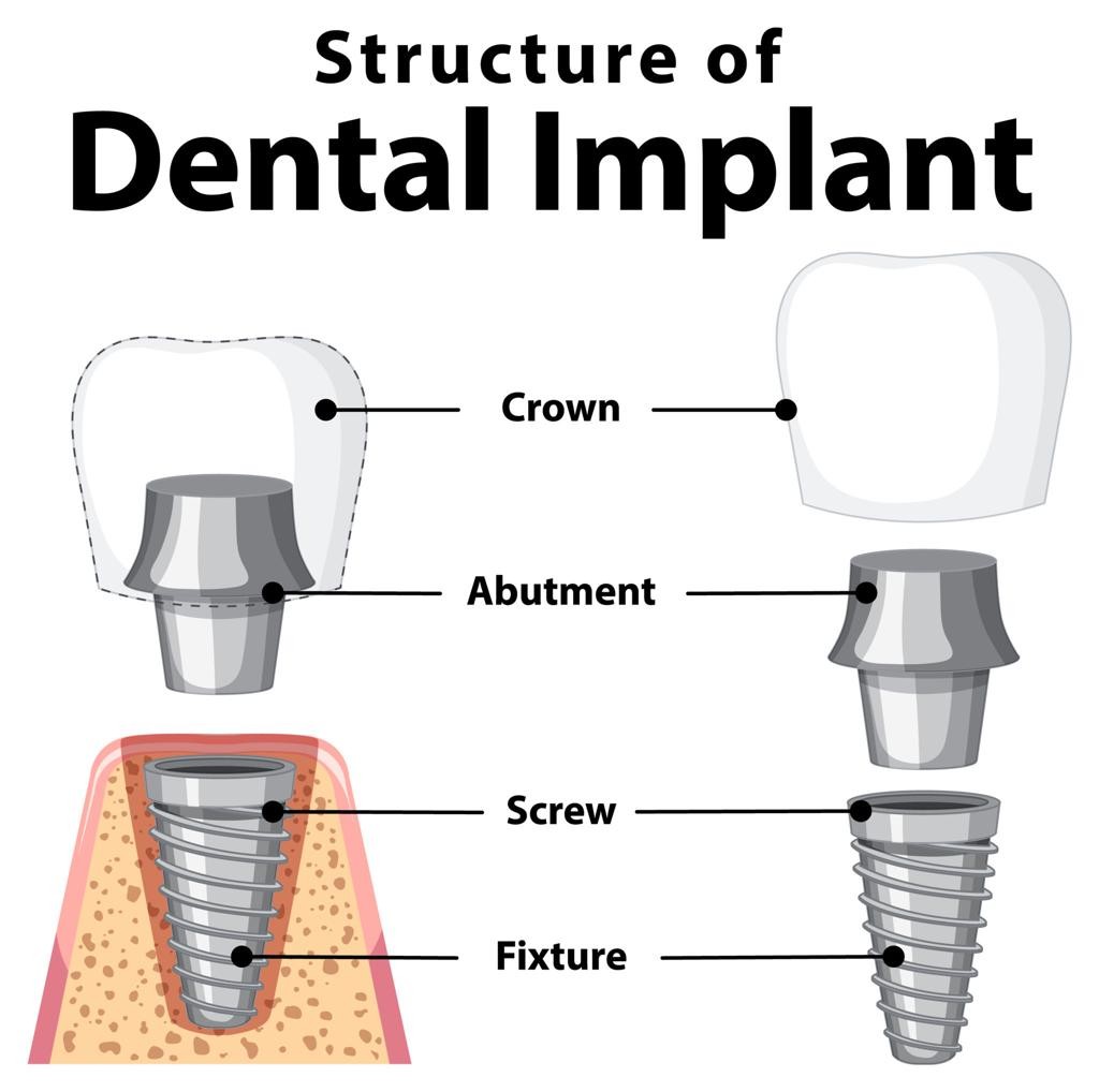 Dental implants for better chewing ability