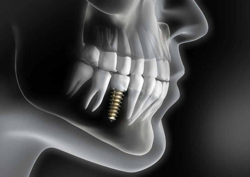 Restored smile and chewing confidence with dental implants