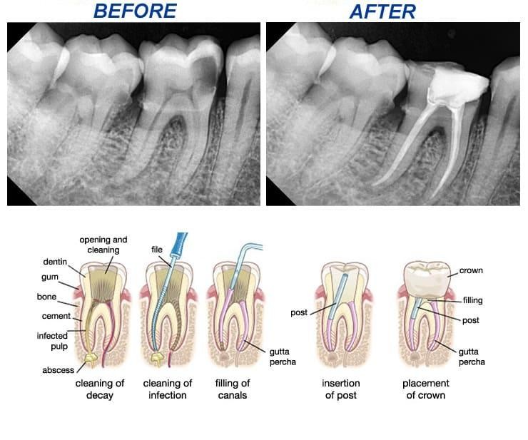Root canal diagnosis and treatment process