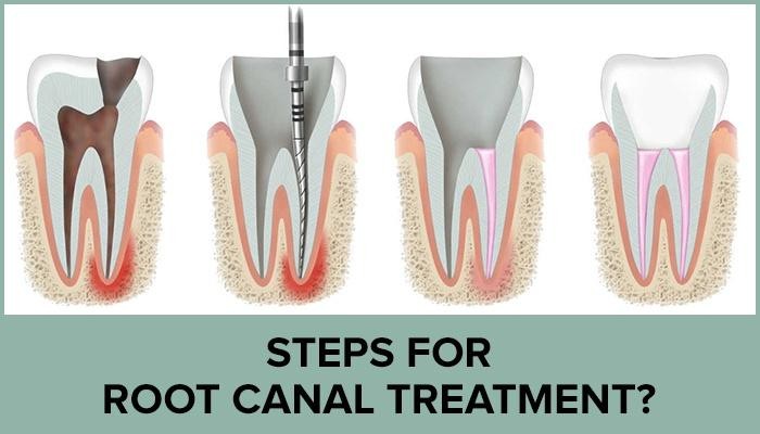 Severe tooth pain and root canal treatment